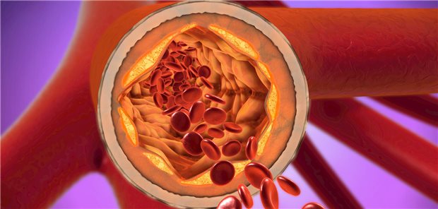 Der PCSK9-Inhibitor Evolocumab reduziert das LDL-Cholesterin im Blut um zusätzliche 55%. Das vermindert eine weitere Plaque Bildung in den Blutgefäßen. 