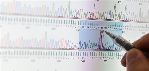 Der Patient wird auf eine C287Y-Mutation im HFE-Gen untersucht. Das Ergebnis, eine homozygote Mutation, bestätigt die Verdachtsdiagnose: Der Patient leidet an einer Hämochromatose.