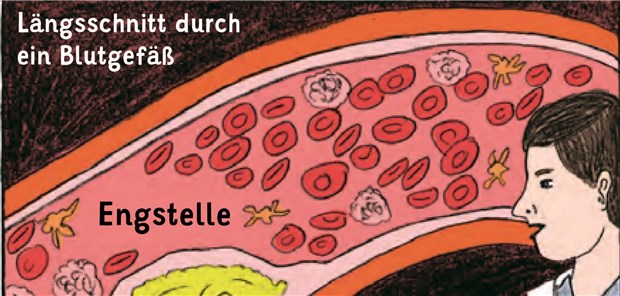 Wenn Comics die Op erklären Der Patientencomic zur Aufklärung über den Eingriff folgt dem Drehbuch eines konventionellen Comics.