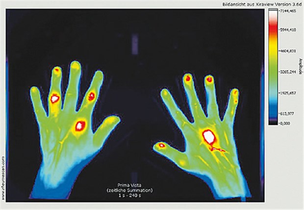 Der Rheumascan® deckt Unterschiede in der Kontrastmittelanreicherung entzündeter Areale auf.