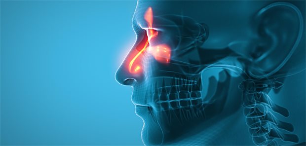 Eine 3d-Illustration des menschlichen Kopfes mit Rhinosinusitis.
