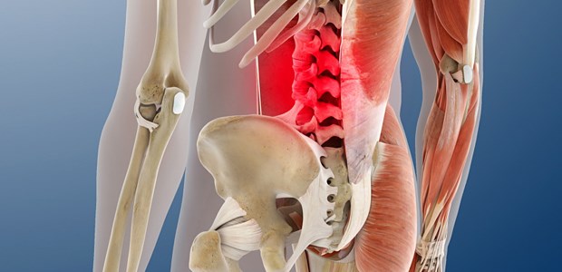 Wenn Psoriasis auf die Gelenke schlägt Der Rücken schmerzt - Psoriasisarthritis betrifft nicht immer nur die peripheren Gelenke, sondern auch das Achsenskelett kann beteiligt sein.