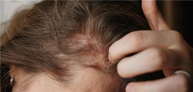 Nahaufnahme wie eine Frau rote und juckende Hautflecken am Kopf krazt.