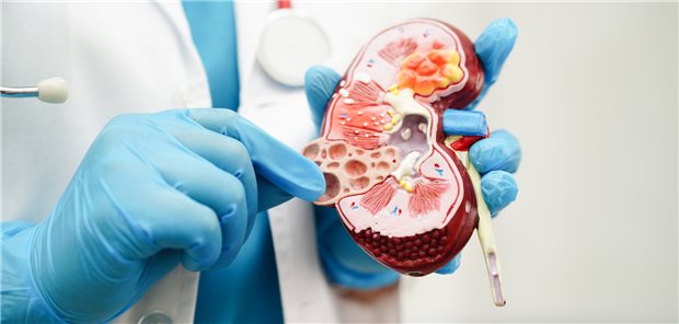 Der Verlauf einer APOL1-Nephropathie ist individuell sehr unterschiedlich. Begleitfaktoren wie Virusinfektionen oder eine Hypoxie beschleunigen ihn. (Symbolbild)