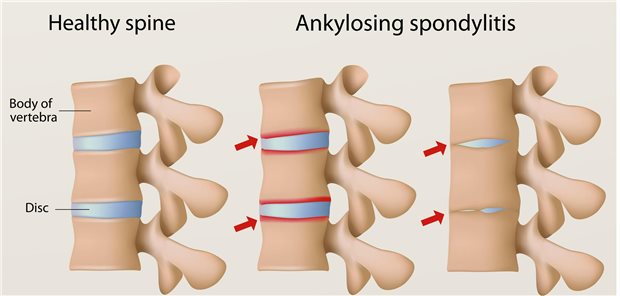 Der aktuelle Standard in der Therapie der axialen Spondylarthritis sind TNF-Inhibitoren. Für Personen, die auf eine Anti-TNF-Therapie nicht ausreichend ansprechen, gibt es als neue Therapiealternativen den Interleukin-17-Inhibitor Bimekizumab und den Januskinase(JAK)-Inhibitor Upadacitinib.