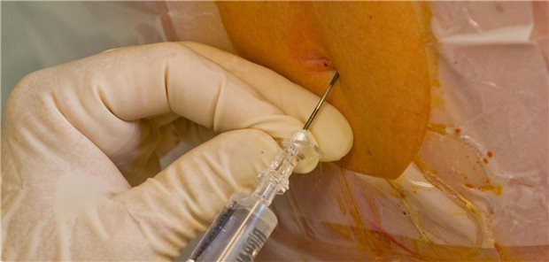 Ein Patient erhält eine epidurale Injektion.