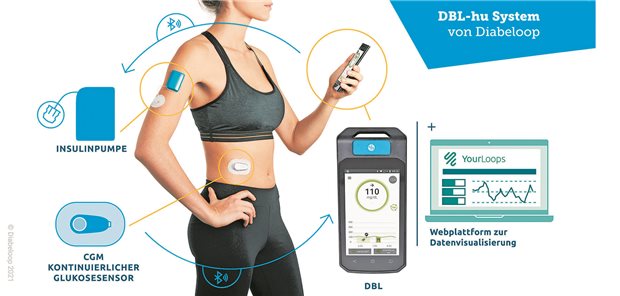 Der „closed loop“ aus Insulinpumpe, CGM-Sensor und dem Handset mit dem DBL-hu-Algorithmus.