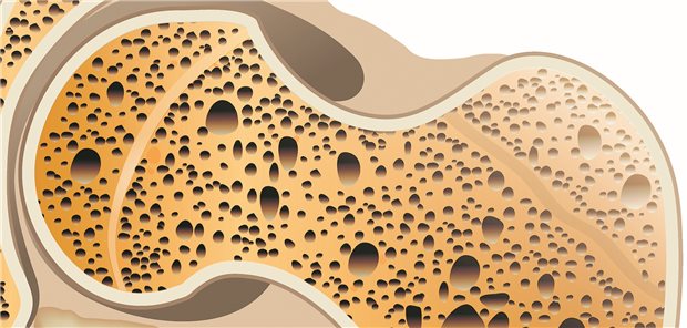 Der osteoporosespezifische Nutzen von Bisphosphonaten wurde in einer Studie anhand der Inzidenz von Hüftfrakturen bewertet.