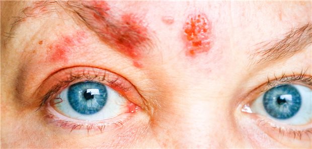 Ausschlag im Gesicht und um das Auge herum, so genannter ophthalmischer Herpes zoster.
