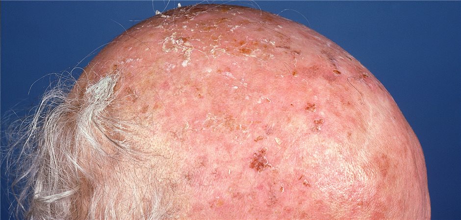 Aktinische Keratose und Plattenepithelkarzinom S3Leitlinie aktualisiert