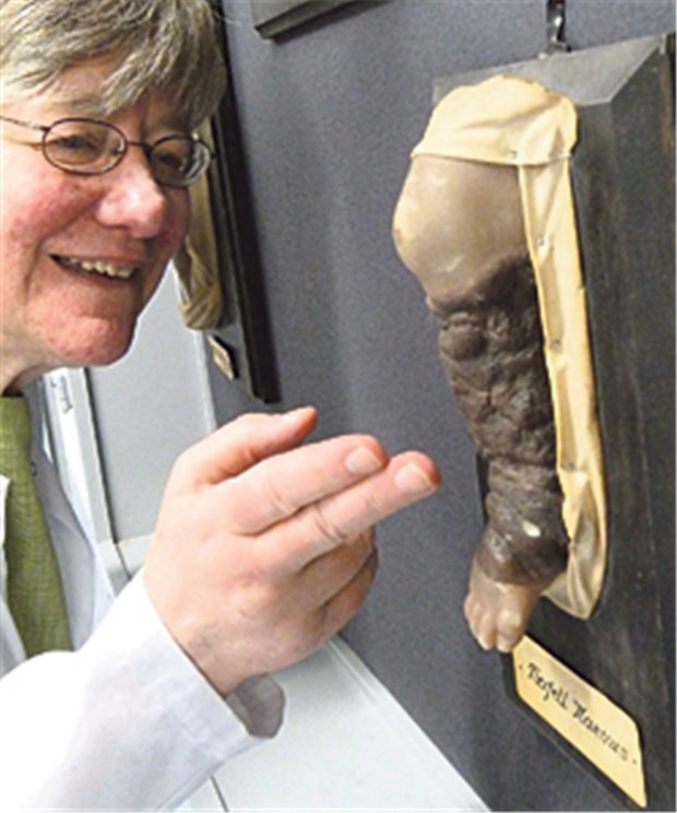 Das Marburger Gruselkabinett Dermatologin Hannelore Mittagsogenannten zeigt den "Tierfell-Naevus", eine sehr seltene Krankheit, die heute "Badeanzug-Pigment-Mal" heißt.