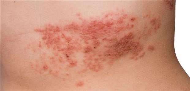 Dermatombezogene Bläschen sind ein typisches Symptom von Herpes zoster. Diverse Komplikationen können zusätzlich auftreten.