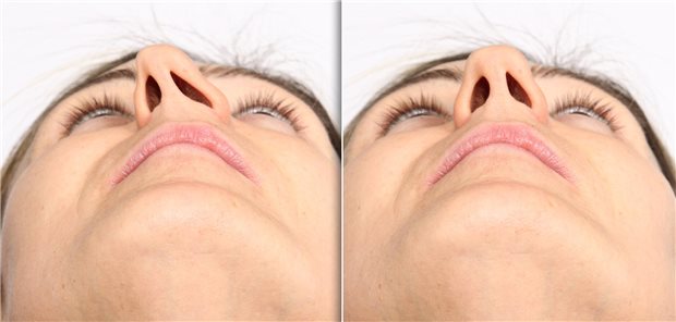 Deviated nasal septum before and after septoplasty surgery comparison