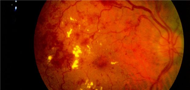 Diabetische Retinopathie: Wegen der undichten Gefäße sehen Betroffene verschwommen, doppelt, kontrastarm und flottierende Flecken.