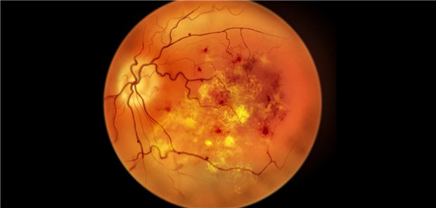 Diabetische Retinopathie im Ophthalmoskop