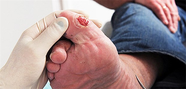 Diabetischer Fuß: Die vom GBA empfohlene Sauerstofftherapie bringt nichts, kritisieren Forscher.