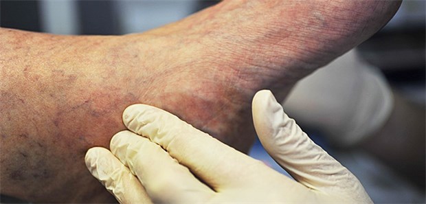 Diabetischer Fuß oder noch nichts Chronisches? Für die weitere Behandlung und für die Abrechnung ist dieser kleine Unterschied entscheidend.