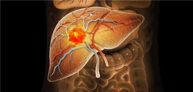 Diagnose: Leberkrebs! Insbesondere bei der Systemtherapie von hepatozellulären und biliären Karzinomen gibt es neue Empfehlungen in der aktualisierten S3-Leitlinie. (Symbolbild)