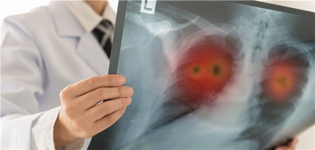 Diagnose Lungenkrebs: In Deutschland wächst der Anteil der Betroffenen jährlich – wenn auch leicht.