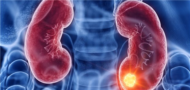 Diagnose Nierenkrebs: In Thüringen ist der Bevölkerungsanteil der betroffenen Menschen im Vergleich besonders hoch.