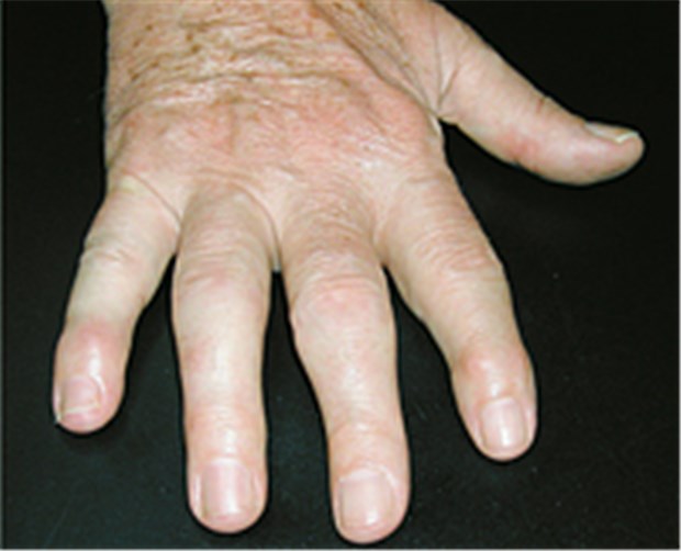 Praxistaugliche Empfehlungen zur Therapie bei Psoriasis-Arthritis Dicke Endgelenke - PsoriasisArthritis?