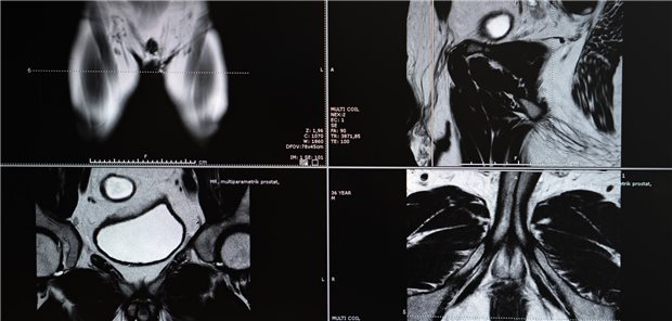 Die Ärztinnen und Ärzte um Nordström bestimmten den PSA-Wert der Patienten, lag dieser über 1,5 ng/ml, erfolgte die Bestimmung des STHLM3-Scores. War auch dieser erhöht oder lag der PSA über 3 ng/ml, ordneten sie eine weitere Untersuchung an – entweder gleich per Biopsie (Kontrollgruppe) oder erst per MRT, und dann gegebenenfalls per Biopsie.