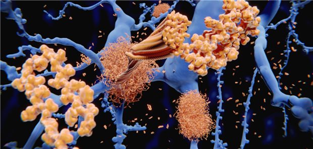 Die Alzheimer-Demenz ist eine neurodegenerative Erkrankung, bei der es zur Bildung extrazellulärer Amyloidplaques kommt.