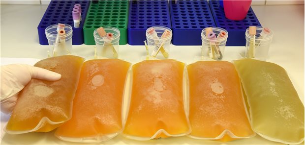 Blutplasma droht durch Corona zum knappen Gut zu werden Die Angst vor dem Coronavirus hat auch Auswirkungen auf die Spendebereitschaft von Blutplasma.