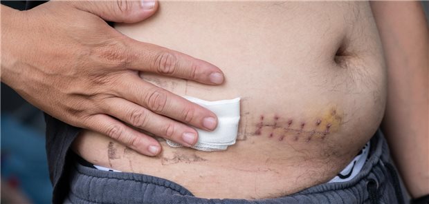 Ein Mann zeigt seine Narbe am Bauch.