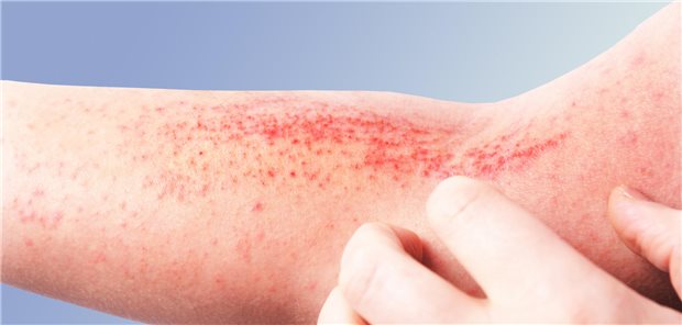 Fein schuppendes, unscharf begrenztes Erythem beugeseitig