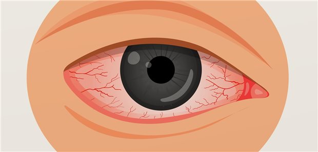 Die Autoren und Autorinnen der retrospektiven Kohortenstudie aus Südkorea resümieren, dass es wichtig ist, aufmerksam zu sein und im Kontext von Impfungen, einschließlich COVID-19-Impfungen, auf Uveitiden zu achten, besonders bei Personen mit Uveitis-Vorgeschichte. 