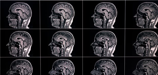 Die Autoren und Autorinnen resümieren, dass das DWI-Scrolling-Artery-Zeichen das Screening auf RZA während der Untersuchung mittels Magnetresonanztomografie ermöglicht und in einem Schnellverfahren verwendet werden kann, wenn Riesenzellarteriitis vermutet wird.
