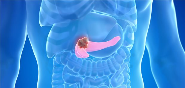 Die Autoren und Autorinnen resümieren, dass in ihrer vergleichenden Kohortenstudie die Überwachung von Hochrisikopersonen für ein Pankreaskarzinom mithilfe von Endosonografie und MRT an akademischen Zentren zur Diagnose kleinerer Krebstumoren und einem größeren Anteil von Patienten im Stadium I führte. 