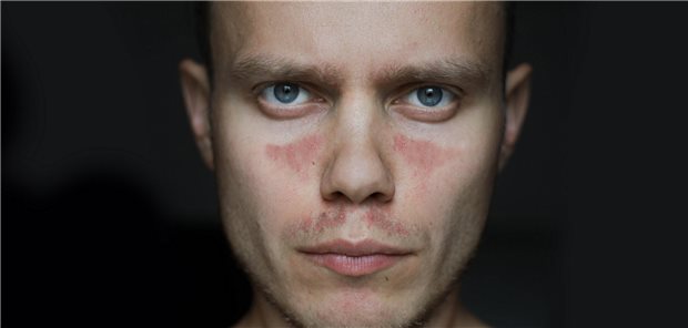 Die Autoren und Autorinnen resümieren, dass es wichtig sei zu bedenken, dass normale High-Density-Lipoprotein-Cholesterin Werte nicht unbedingt auf funktionelles High-Density-Lipoprotein (HDL) bei Patienten mit systemischem Lupus erythematodes (SLE) hinweisen. Der funktionelle Aspekt von HDL bei Patienten mit SLE ist genauso wichtig wie dessen quantitative Bewertung.