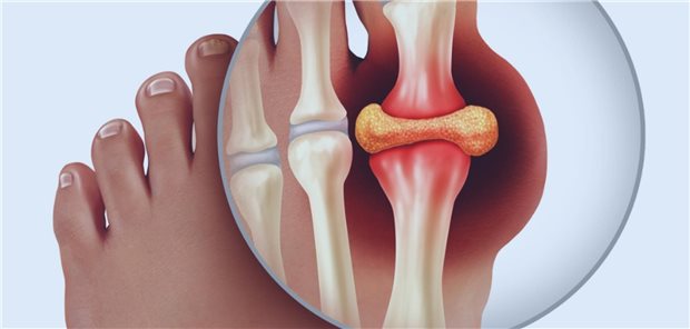 Autoren und Autorinnen weisen darauf hin, dass kristallinduzierte entzündliche Gelenkerkrankungen sich zwar typischerweise in Schüben manifestieren, aber auch persistierende Verläufe möglich sind. Es sollten nicht nur aktuell Beschwerden bereitende Gelenke, sondern auch typische Prädilektionsstellen wie das Großzehengrundgelenk bei Gichtverdacht, Knie und Handgelenke bei CPPD und die Schultern bei BCPD untersucht werden.