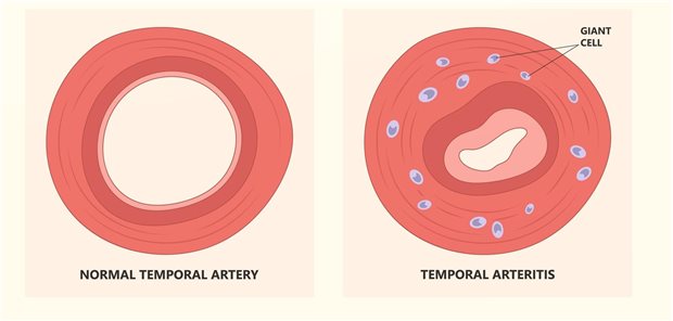 Vergleich des Aussehen eines Querschnittes einer normalen Schläfenarterie (links) und einer Schläfenarteie bei Riesenzellarteriitis (rechts).