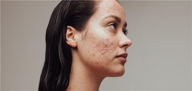 Seitenansicht einer Frau mit Akne.