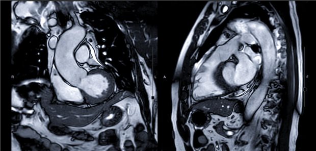 Die Autorinnen und Autoren betonen, dass es derzeit keine publizierten Leitlinien für die Diagnose der IIM-Myokarditis gibt. Hinweisen aus Anamnese und Basisuntersuchungen, etwa einer linkventrikulären Dysfunktion im Herzultraschall, ist nachzugehen. Technische Fortschritte und ein verbesserter Zugang zu moderner Bildgebung, wie der cMRT, erlauben es, myokardiale Entzündungen und Vernarbungen nicht-invasiv sichtbar zu machen.