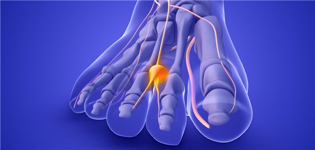 Symbolische Darstellung des Morton-Neuroms