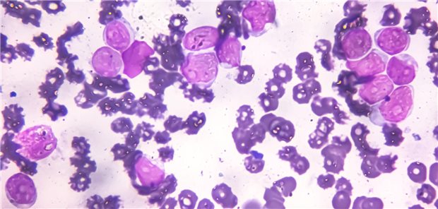 Peripherer Blutausstrich unter dem 100-fachen Lichtmikroskop zur Diagnose der akuten lymphatischen Leukämie.