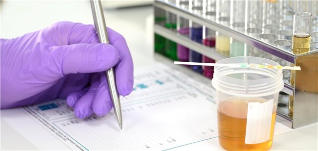 Urinprobe eines Patienten der SGLT2-Hemmer einnimmt wird im Labor auf eine SGLT2i-assoziierte Ketoazidose untersucht.