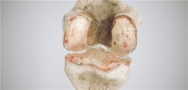 Die Autorinnen und Autoren resümieren, dass Patienten, die Zoledronsäure erhalten haben, wegen der Medikation eine erhöhte Knochendichte und Knochenrigidität haben, was wiederum das Fortschreiten der Arthrose begünstigt haben könnte. 