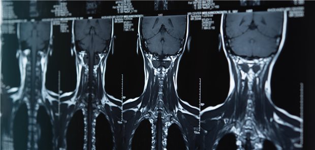 Die Autorinnen und Autoren resümieren, dass Zufallsbefunde im Halsbereich beim CT-Screening auf Lungenkrebs unvermeidbar sind und wegen ihres Potenzials für Malignität eine adäquate Nachverfolgung und Abklärung erfordern.