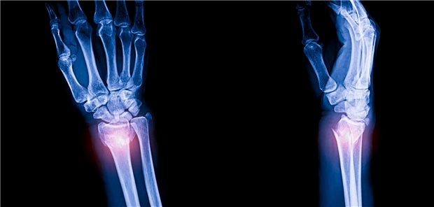 AP- und Seitenansicht eines Röntgenbild einer distalen Radiusfraktur (Colles-Fraktur). 