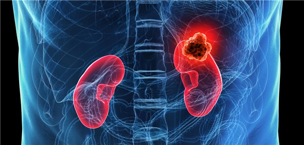 Die Autorinnen und Autoren resümieren, dass bei Patienten mit rezidivierten Nierenzellkarzinom der HIF-2α-Inhibitor Belzutifan eine Behandlungsoption darstellen könnte.