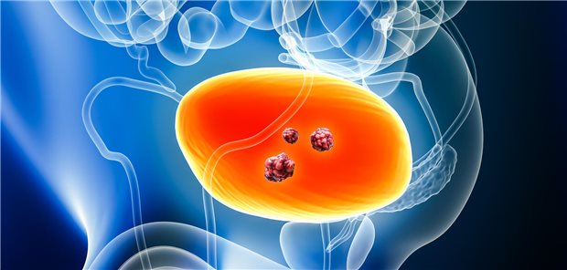 Die Autorinnen und Autoren resümieren, dass bei einer Entscheidung für Mitomycin C viel für eine Induktionstherapie spreche, gefolgt von einer einjährigen Erhaltungstherapie mit 40 mg pro monatlicher Instillation. Hiermit würden ähnliche Zwei-Jahres-RFS-Raten wie mit BCG erzielt.