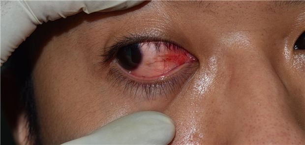 Die Autorinnen und Autoren resümieren, dass bei einer typischen Kontaktlinsen-assoziierter Keratitis ersten oder zweiten Grades eine Entlassung unter empirischer Behandlung mit topischen Fluorchinolonen möglich ist, sofern im Falle einer Befund- oder Symptom-Verschlechterung ein leichter Zugang zu einer neuerlichen Überprüfung in einem tertiären Zentrum gegeben ist.