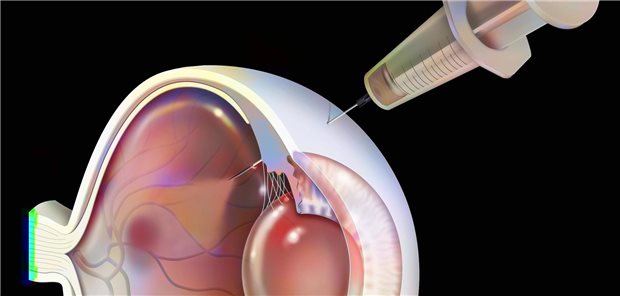 Grafik: Injektion in einen Augapfel im Querschnitt