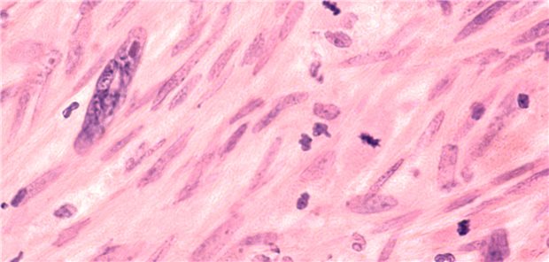 Mikroskopische Aufnahme eines Leiomyosarkoms, einer Art Weichteilsarkom der glatten Muskulatur. Dieser bösartige Tumor tritt typischerweise in der Gebärmutter oder im Magen-Darm-Trakt auf.