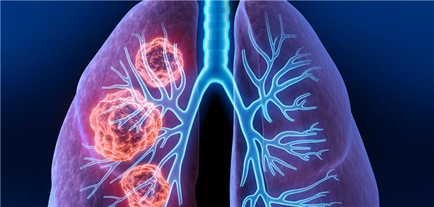 Die Autorinnen und Autoren resümieren, dass die Kombination aus Plinabulin und Docetaxel als Zweit- oder Drittlinientherapie für eine Patientengruppe mit erheblichem ungedecktem medizinischem Bedarf in Betracht gezogen werden könnte.